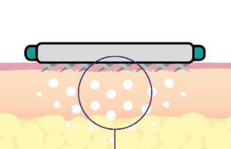 AN ANGLED MICRONEEDLE PATCH FOR ENHANCED DRUG AND VACCINE DELIVERY
