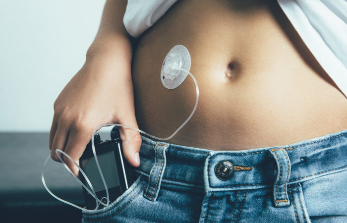 Young diabetic patient keeps an insulin pump in the pocket